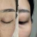 4928 | 대구동구피부관리 뷰티온화 콜드플라즈마로 잡티관리 받고 온 후기