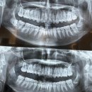 광주치과의원 | [사랑니 발치 후기] 매복사랑니 / 광주 쏙쏙사랑니 치과의원 / 병원추천 / 가격 / 사랑니 발치 후 뿌리...