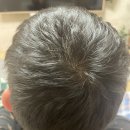 Before &amp; After 공개 ㅣ남편 탈모 관리 리얼 후기 ㅣ 탈모병원 추천!