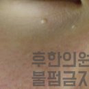 한선한의원 | 창원 비립종 한관종 눈 밑 오돌토돌한 돌기, 제 가족이라면...이렇게 합니다
