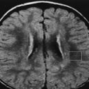 리 증후군(Leigh syndrome) 뇌 신경정신질환, 유전질환이란? 이미지