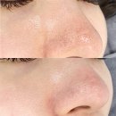 고원장의모공세척테라피구월점 | 미사 모공관리 고원장의모공세척테라피 미사점 후기, 코 피지와 모공세척 수분케어 비포애프터 보고...