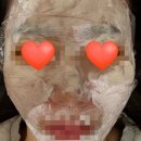 부천아이디의원 | [부천시청] 부천아이디의원 어븀야그레이저 몽땅제거 후기, 관리, 비용