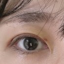 바로나한약국 | 대구 성형외과 매몰 쌍수(쌍커풀수술) 후기