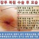 장루 복원 수술 후의 치료 이미지