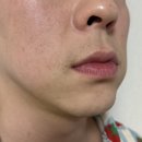 강남역 레이저 제모 젠맥스프로플러스 효과 후기 , 수염 제모 1회차 ~5회차 통증 가격