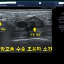 맘모톰 수술 후기 ;; 3cm 유방 섬유선종 맘모톰 수술 후 2년 feat;; SNU서울외과