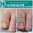 &#34;청라발톱무좀 관리와 함께하는 특별한 하루, 닥터아이티엔네일위드유에서&#34;