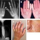 경피증[systemic sclerosis] 이미지