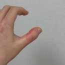 해운대산부인과의원 | 임산부 손가락 2도 화상 부산 화상병원 센텀화외과의원 다녀온 경과 및 치료 후기 (사진 혐오 주의)