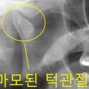 부원뉴욕치과병원 | 턱관절 통증 병원, 고딕아치 없이 장치만 끼면 부작용...있습니다 (마우스피스, 스플린트 치료 관련 후기)