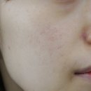 스누피부과의원 | 피부 혈관확장치료 DDR 레이저 2회차 후기!!! (피부사진많음)