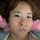 죽전바른신경과의원 | 대구 죽전동 더차오름의원 피코 프락셀 얼굴 전체 6개월 기록 솔직후기 내돈내산