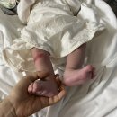 뚜레쥬르 경북대병원점 | 경북대 피부과 아기 무릎 혈관종 수개월간 치료 후기 (이석종 교수님)