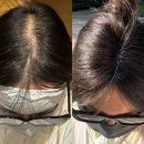종로태양약국 | 종로 로게인폼 약국 가격 내돈내산 사용후기 용량 부작용 사용법