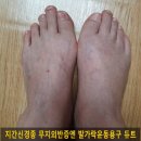 지간신경종 무지외반증엔 발가락운동용구 듀트-신체발란스운동 이미지