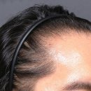 더(THE)건강한병원 | 파주탈모병원, 헤어라인부터 정수리까지 진행된 탈모치료 3개월차 후기