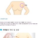 수원강남여성병원에서 알려드리는 '부유방'이란? 이미지