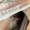 신생아 백일전후 아기 스킨텍(쥐젖) 성형외과 제거수술 정보