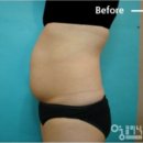 진례의원 | 복부지방흡입과 복부리프팅 동시 진행 후 체형 변화에 대한 진례기록