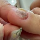 나도손톱 레푸스 개봉점 | 양재동 네일샵, 젤네일 손톱 곰팡이 해결 후기