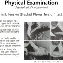 Upper limb tension (Brachial Plexus Tension) test(상완신경총 검사) 이미지