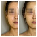 홍성 피부관리 '엘라인 이지다' 윤곽 v라인 관리 후기