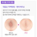 검게 착색된 '항문' 피부톤 자신 있는 핑크로 만들어주는 '항문 미백' 시술 이미지