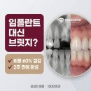 100년치과의원 | 앞니 빠졌을 때 무조건 임플란트? ‘양옆 치아’를 꼭 확인해야 하는 이유 (경기광주 100년치과)