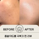 토마토종합약국 | 좁쌀여드름 화장품 추천. 좁쌀여드름 없앤 리얼 후기. 제가 써본 화장품 다 리뷰했어요