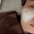 여드름흉터 포텐자 서브시전 후 한의원 새살침 시작 후기
