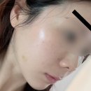 스킨매니아 | 신논현역피부과 올리디아120 콜라겐스킨부스터주사 후기(리쥬란과 차이, 통증, 전후비교)
