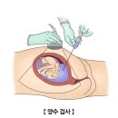 양수2 | 니프티 검사 판정불가 재검 2번 검사 후 양수검사 후기
