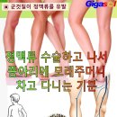 군것질이 얼마나 무서운지를 알아야~정맥류 이미지