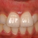 [치아성형] 돌출된 앞니의 라미네이트 치아성형.(치아성형비용/치아성형가격/토끼이빨) 이미지