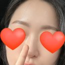 [내돈내산] "10년 넘게 방치했던 켈로이드 흉터, 수술로 해결! 내돈 내산! (함희정 성형외과 후기)”