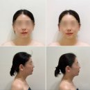 구리남양주 윤곽관리 [셀앤수 에스테틱] JH윤곽술 후기