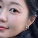 강남한의원 | 강남 편평사마귀 피부과 한의원 거우침 치료 후기 내돈내산