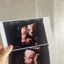 광교은산부인과의원 | [임신기록] 쌍둥이 입체 초음파 / 베이비페이스 👶🏻👶🏻