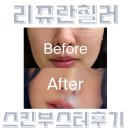 [분당 피부과] 비타민의원 분당점 | 리쥬란힐러 | 샤넬주사 | 더마샤인 | 서현역 피부과
