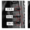 후니아빠님의 경추디스크 C4-5, C5-6, C6-7 MRI 판독입니다. 이미지