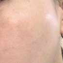 소정약국 | 기미 연고 함익병 크림&amp;약국 크림 후기