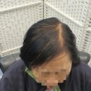 김호증모가발by헤어리서치 이미지