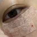 콧대높은 개 | 대전 눈밑지방재배치 지방이식 내돈내산 후기 (수술비용, 통증, 멍 등)