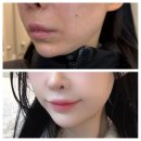 신논현역피부과 슈링크 유니버스 이중턱리프팅 후기