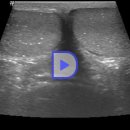 Testicular microlithiasis (32/M) 이미지