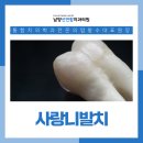 발안선연합치과의원 | 남양읍치과 사랑니 발치, 미루지 말아야 하는 이유