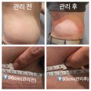 빵빵한 속근육 우리체조 | 배만 만진다고 빠질까? 수성구 복부관리, 상체까지 순환되야 술배가 3cm 줄어듭니다 (실제후기)