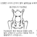 고관절 이형성증 = Hip Dysplasia 이미지