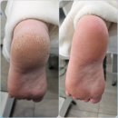 이천 문제성 발 전문#라파엘